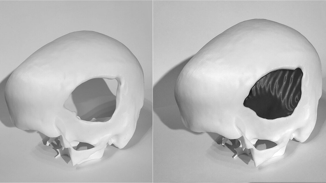 Two illustrative images: the one on the left shows a human skull with a large defect; the right one shows the same skull fragment, but the defect has been filled with an implant.