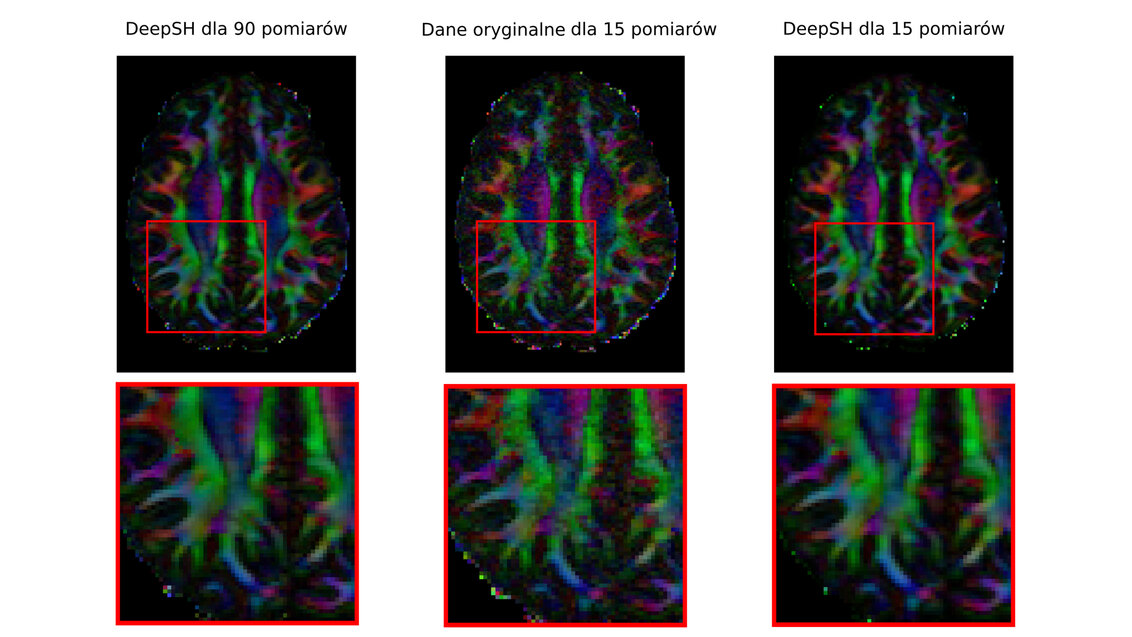 Trzy obrazy mózgu w rzucie od góry ułożone poziomo obok siebie. Obszary o różnym poziomie dyfuzyjności oznaczone są odmiennymi kolorami. Obrazy znajdujące się po lewej i po prawej stronie są dokładniejsze niż obraz pośrodku.