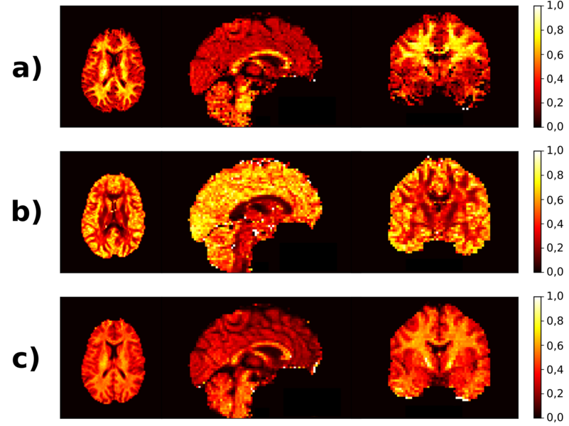 obrazy mózgu uzyskane metodą dyfuzji-relaksometrii w płaszczyźnie poprzecznej, strzałkowej i czołowej. Obrazy mózgu są w kolorze żołto-czerwonym i znajdują się na czarnym tle.