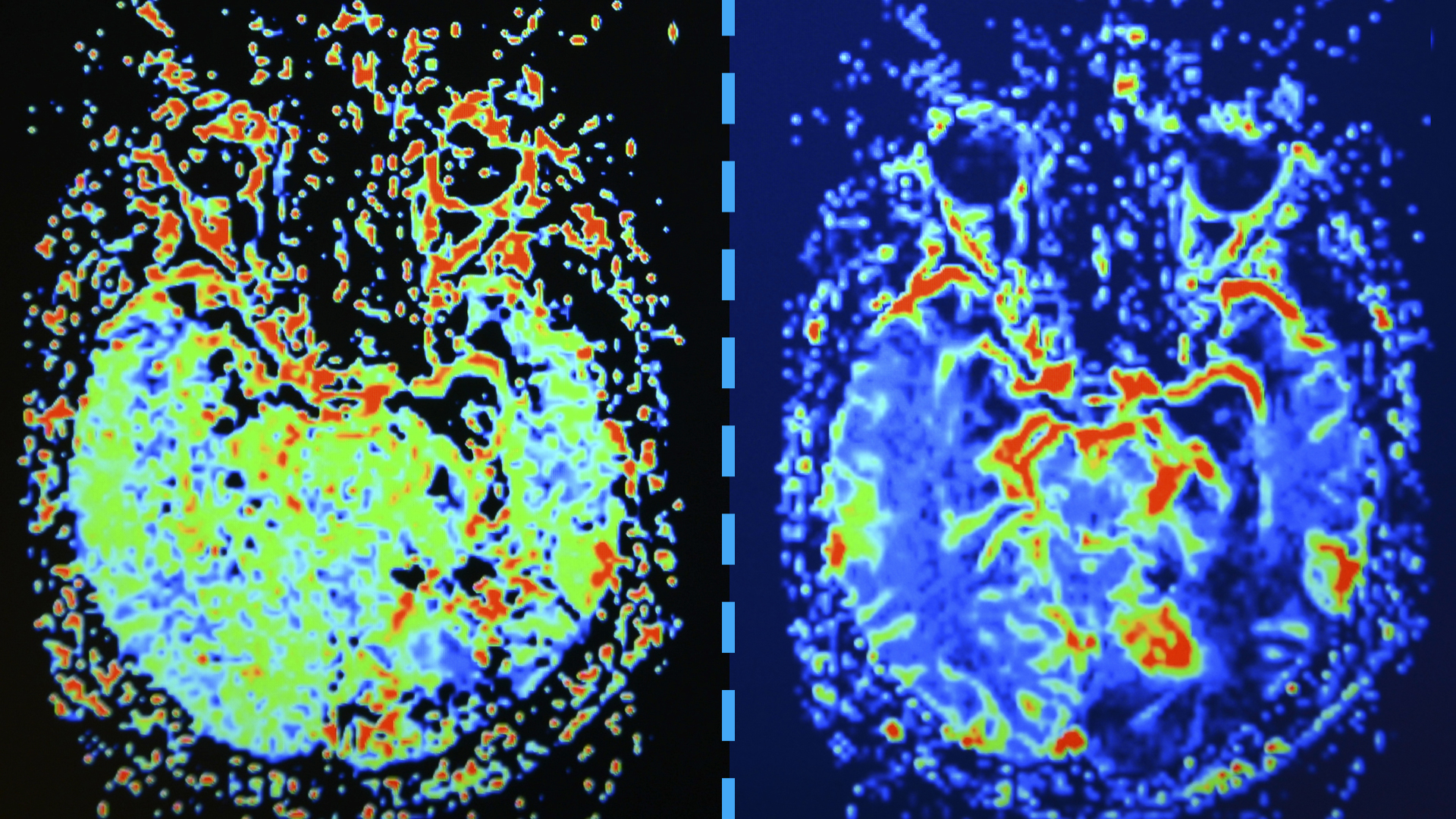 Dwa obrazy z mózgu w rzucie z góry ułożone poziomo obok siebie. Różne obszary oznaczone są odmiennymi kolorami.